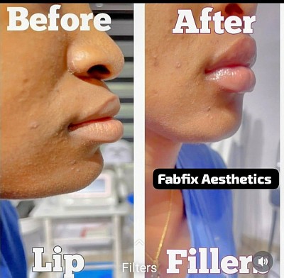What Are Derma Fillers?  Derma fillers are gel-like substances injected beneath the skin to:  Restore lost volume  Smooth lines and wrinkles  Enhance facial contours