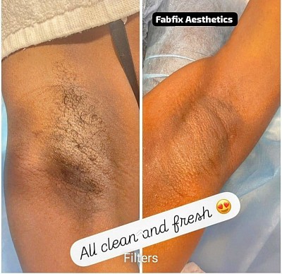 Say goodbye to stubble and hello to smooth, confident skin! At Fabfix Aesthetics, our underarm waxing service is quick, gentle, and leaves your skin hair-free for weeks.  💖 Why Choose Fabfix?  Expert Technique – We use premium hard wax ideal for delicate underarm skin, gripping hair without irritating the skin.  Hygienic & Comfortable – Strict hygiene protocols and soothing pre- and post-wax care ensure a comfortable experience.  Smooth Results – Enjoy up to 4–6 weeks of smoothness with reduced regrowth over time.  Confidence Boost – Perfect for sleeveless outfits, events, or everyday freshness.