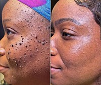 Skin Tag Removal  At Fabfix Aesthetics, we offer safe, non-invasive Skin Tag Removal treatments using advanced technology tailored to your skin type. Whether for cosmetic reasons or comfort, our expert approach ensures minimal discomfort and no scarring.