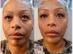 Under eye rejuvenation with Prp treatment