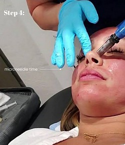 Microneedling at Fabfix Aesthetics  Restore. Renew. Rejuvenate.  Microneedling is a cutting-edge skin rejuvenation treatment that stimulates collagen and elastin production by creating tiny, controlled micro-injuries in the skin. At Fabfix Aesthetics, we offer both Automated and Manual Microneedling techniques tailored to your skin’s unique needs.  Benefits of Microneedling  ✔ Reduces fine lines and wrinkles ✔ Improves acne scars and stretch marks ✔ Tightens and firms sagging skin ✔ Enhances skin texture and tone ✔ Minimizes pores and pigmentation  Why Choose Fabfix?  🔬 Advanced technology with sterile, medical-grade tools 🌿 Combined with serums, PRP, or Meso solutions for enhanced results