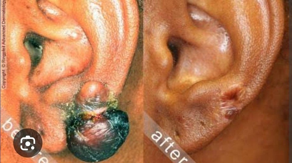 Remove keloid without pain or scar at FABFIX AESTHETICS